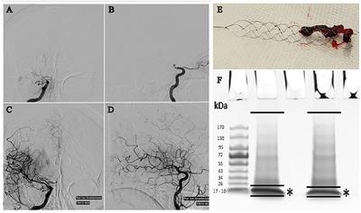 Machine Learning Analysis of the Cerebrovascular Thrombi Proteome in Human Ischemic Stroke: An Exploratory Study